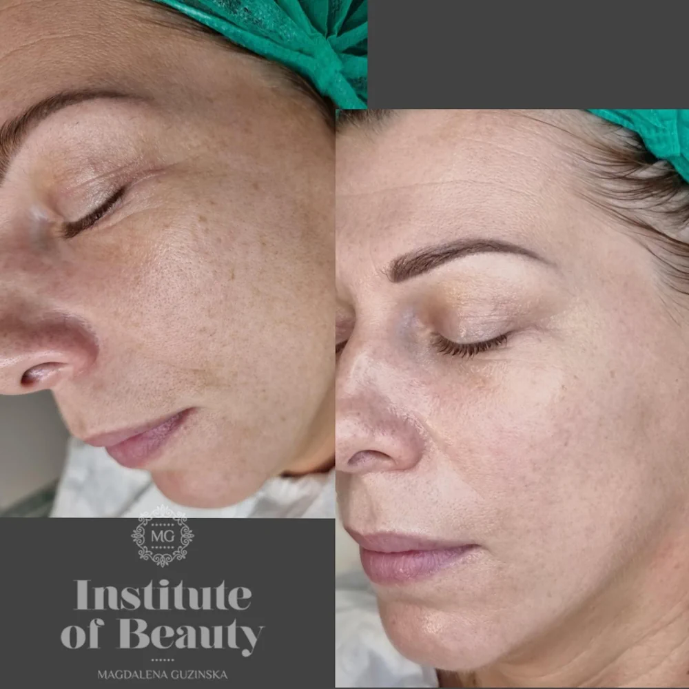 Chemical Peel Cheltenham