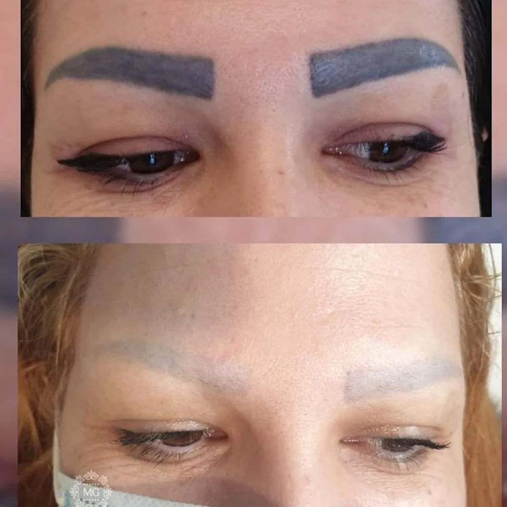 Laser Treatments Cheltenham