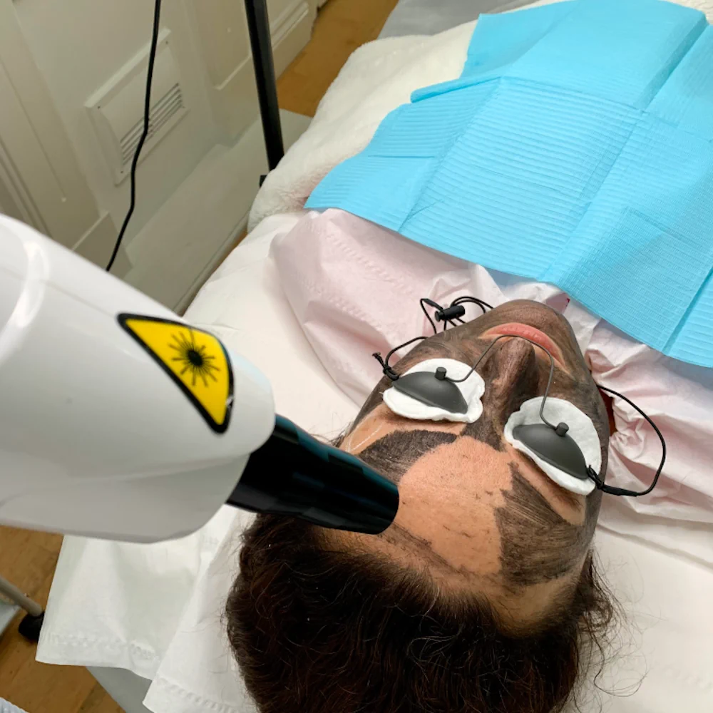 Tattoo Removal Cheltenham