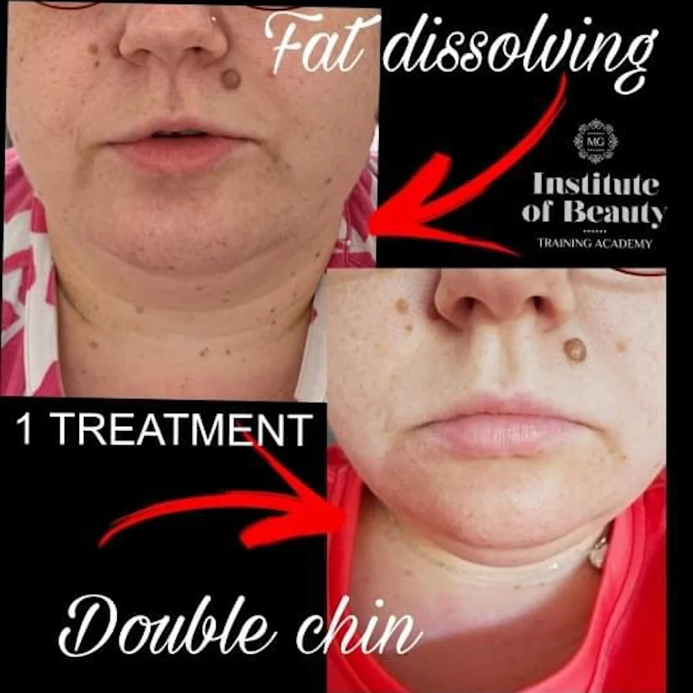 Fat Dissolving