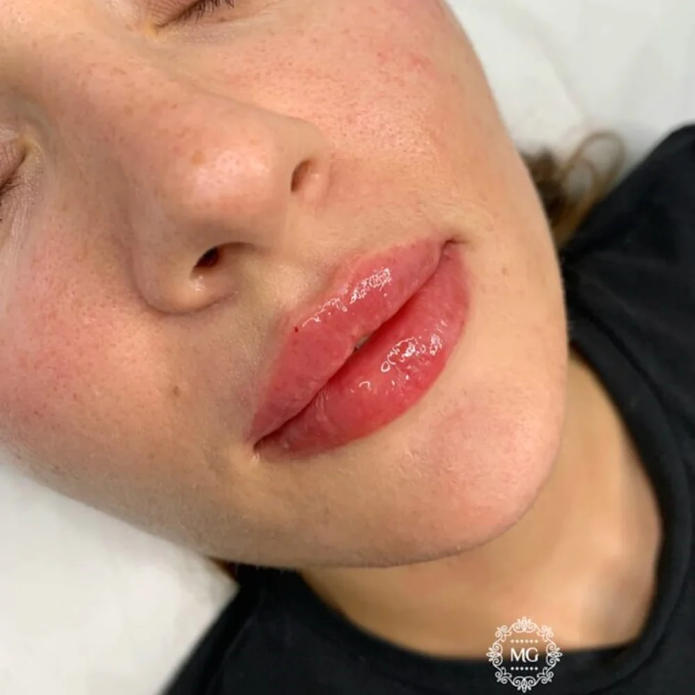 botox and fillers