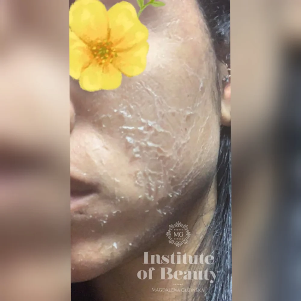 chemical peel 1