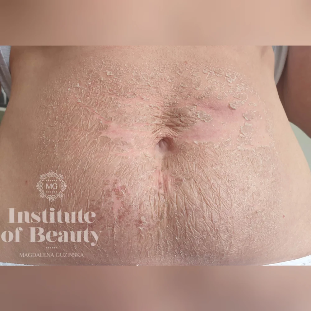 chemical peel 3