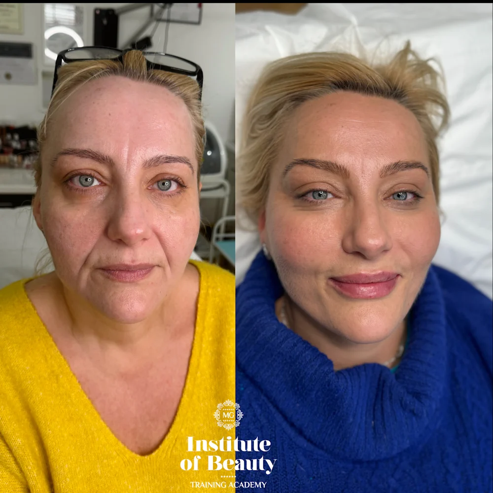 chemical peel